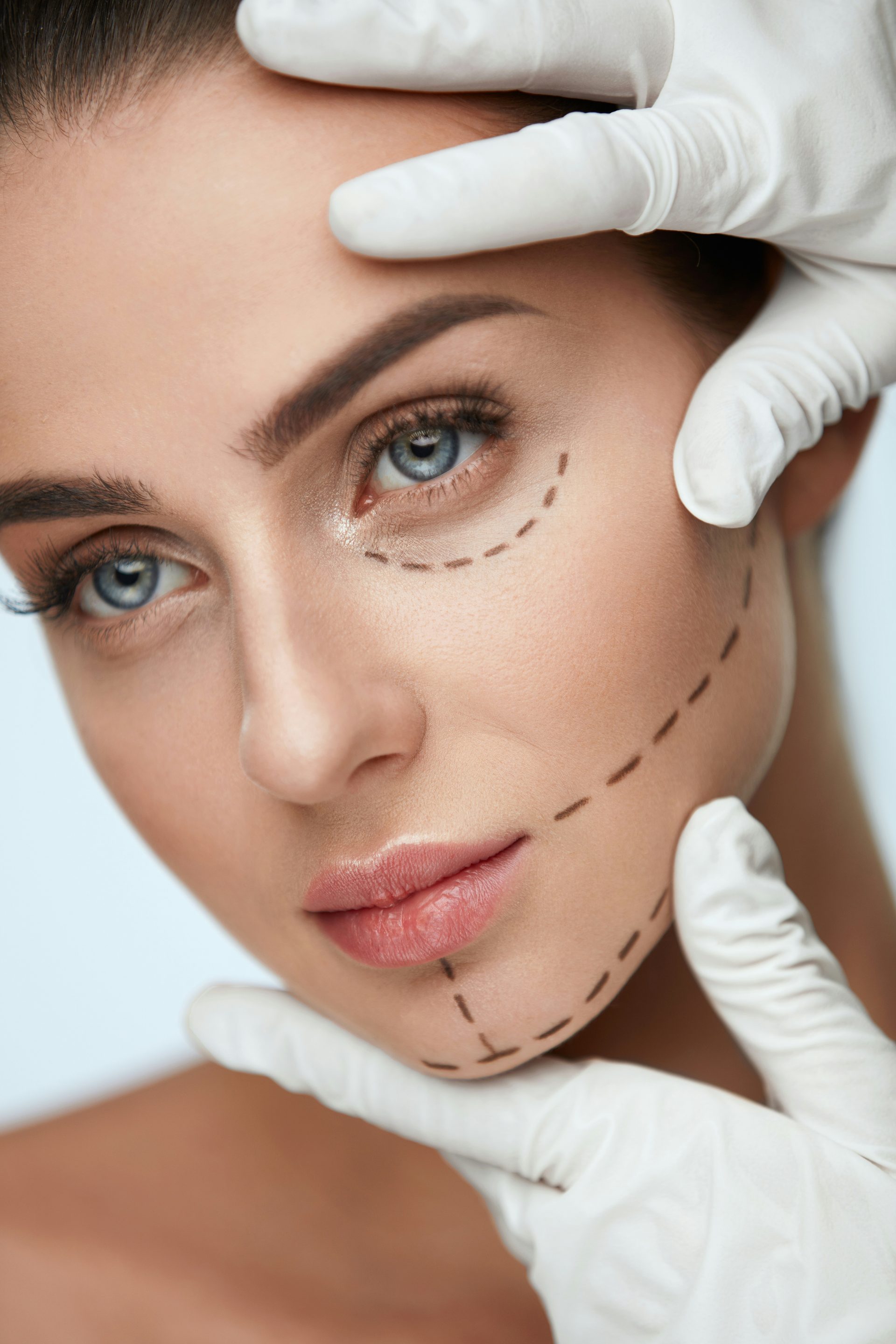 Facelift