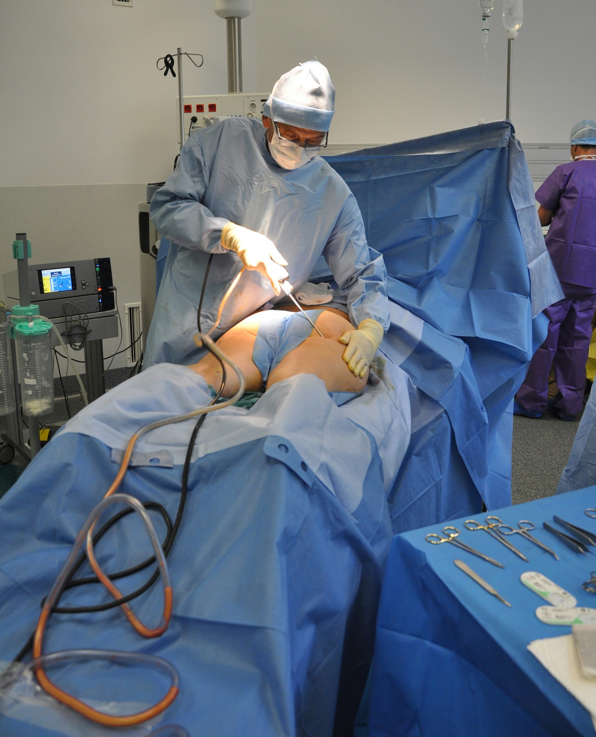 Liposuktion / Fettabsaugung