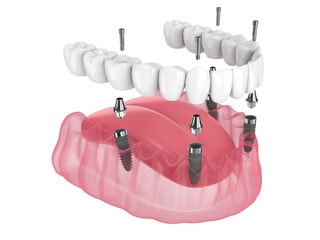 Full-Mouth-Rehabilitation