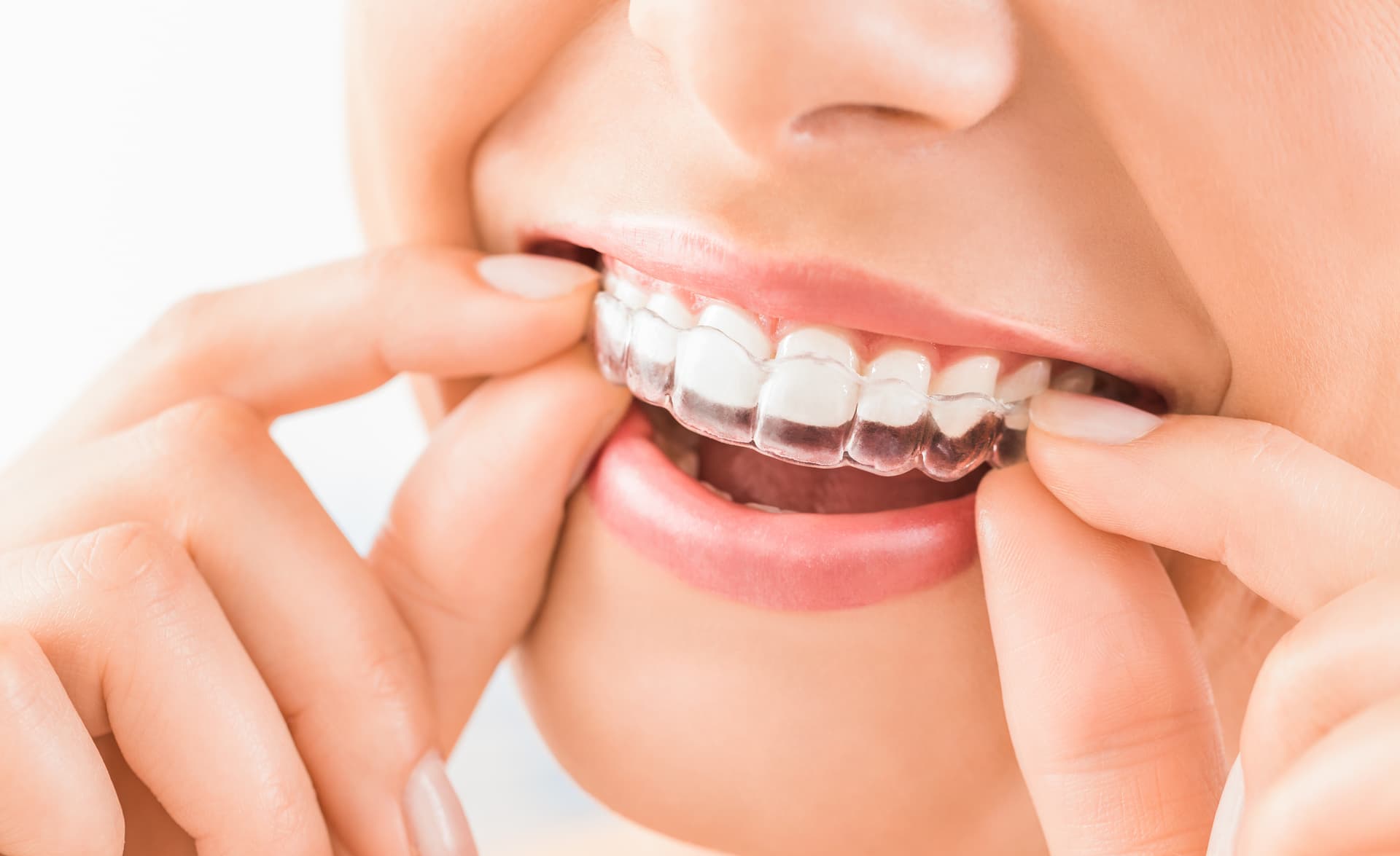 Veneers im Ausland: Kosten, Materialien und der Weg zum neuen Lächeln