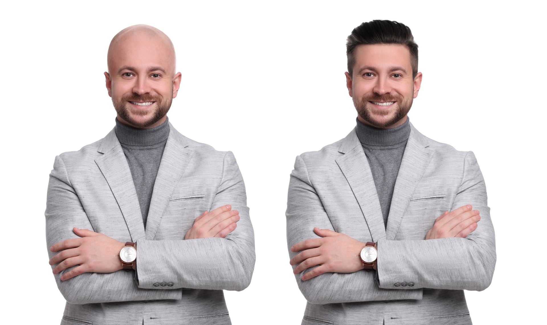 Haartransplantation - FUE-Methode