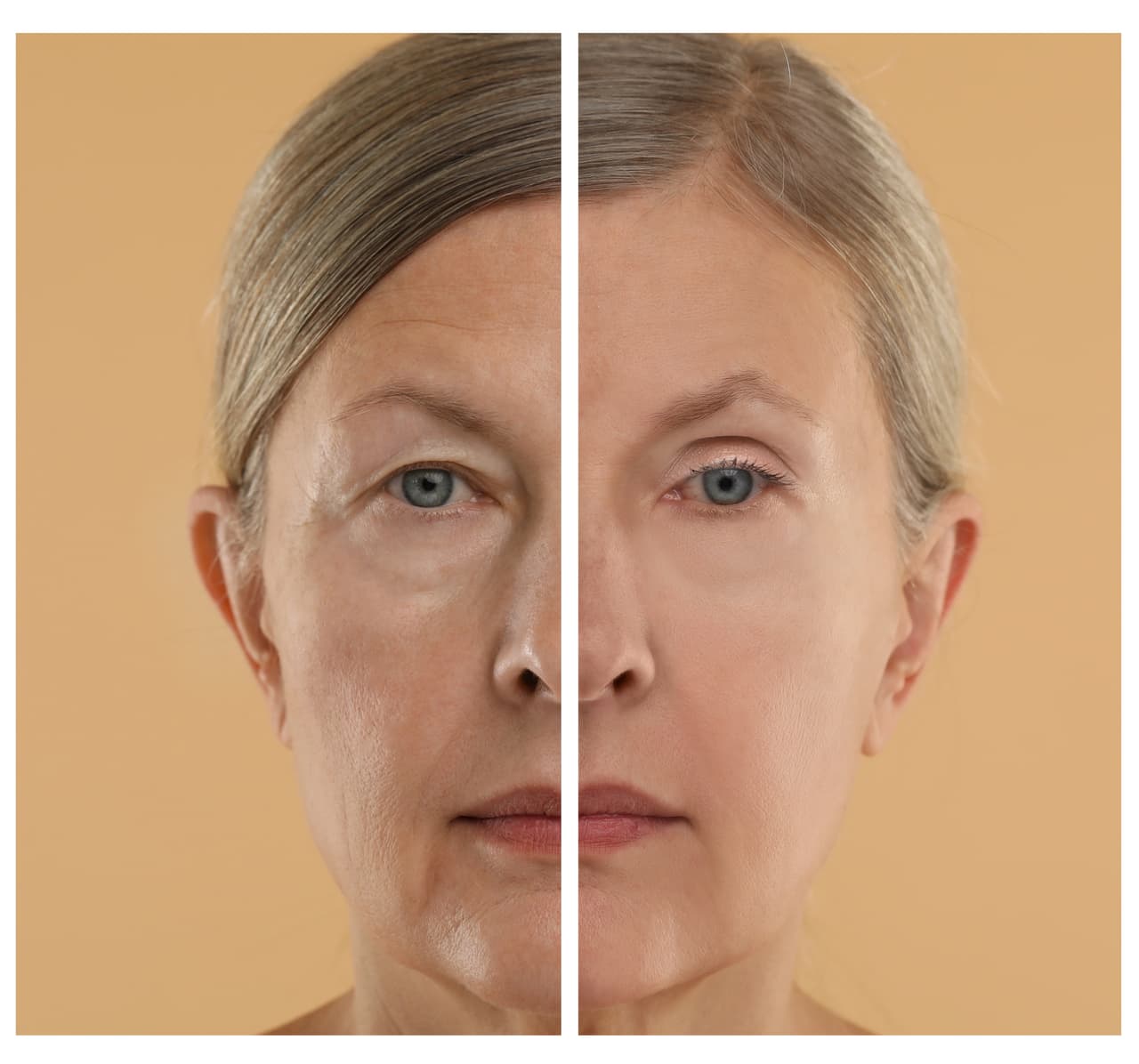 Schönheitsbehandlung im Ausland, Bild Facelift einer älteren Frau vorher nachher