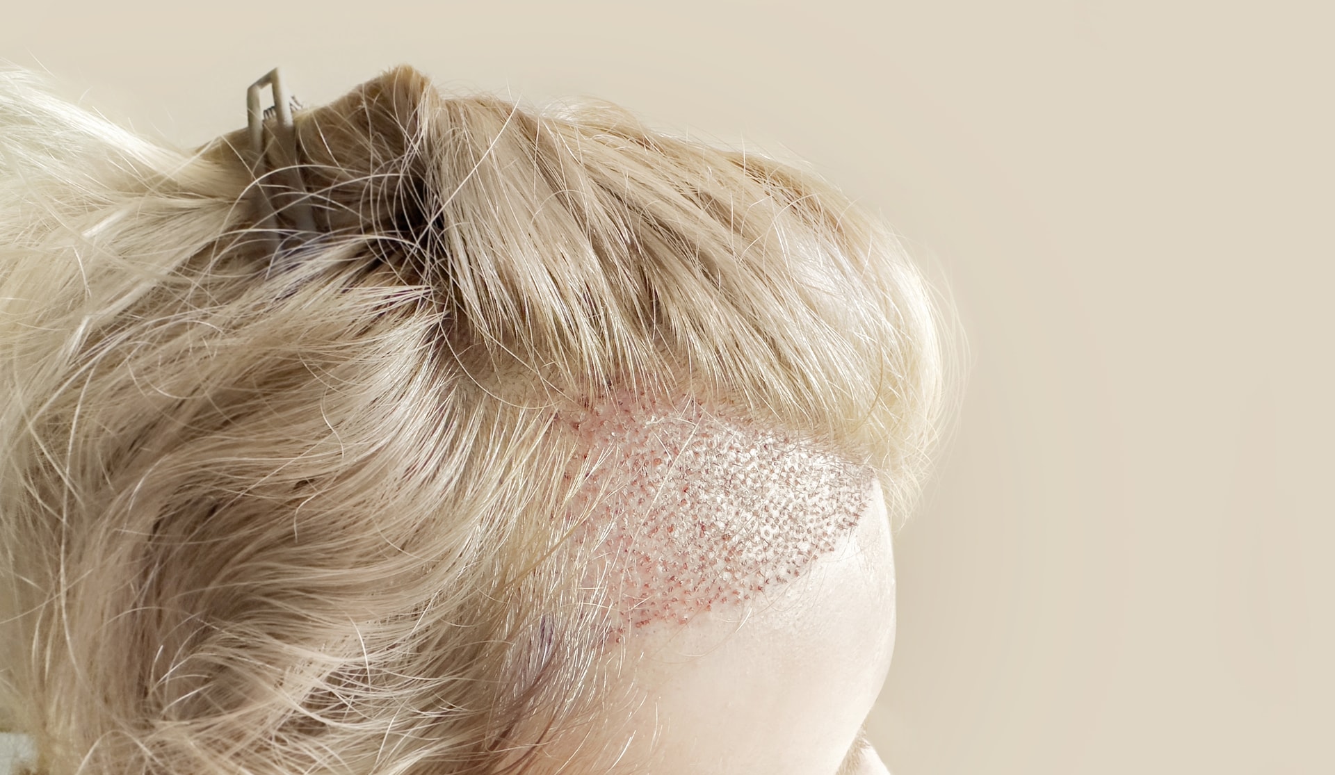 Haartransplantation bei Narben