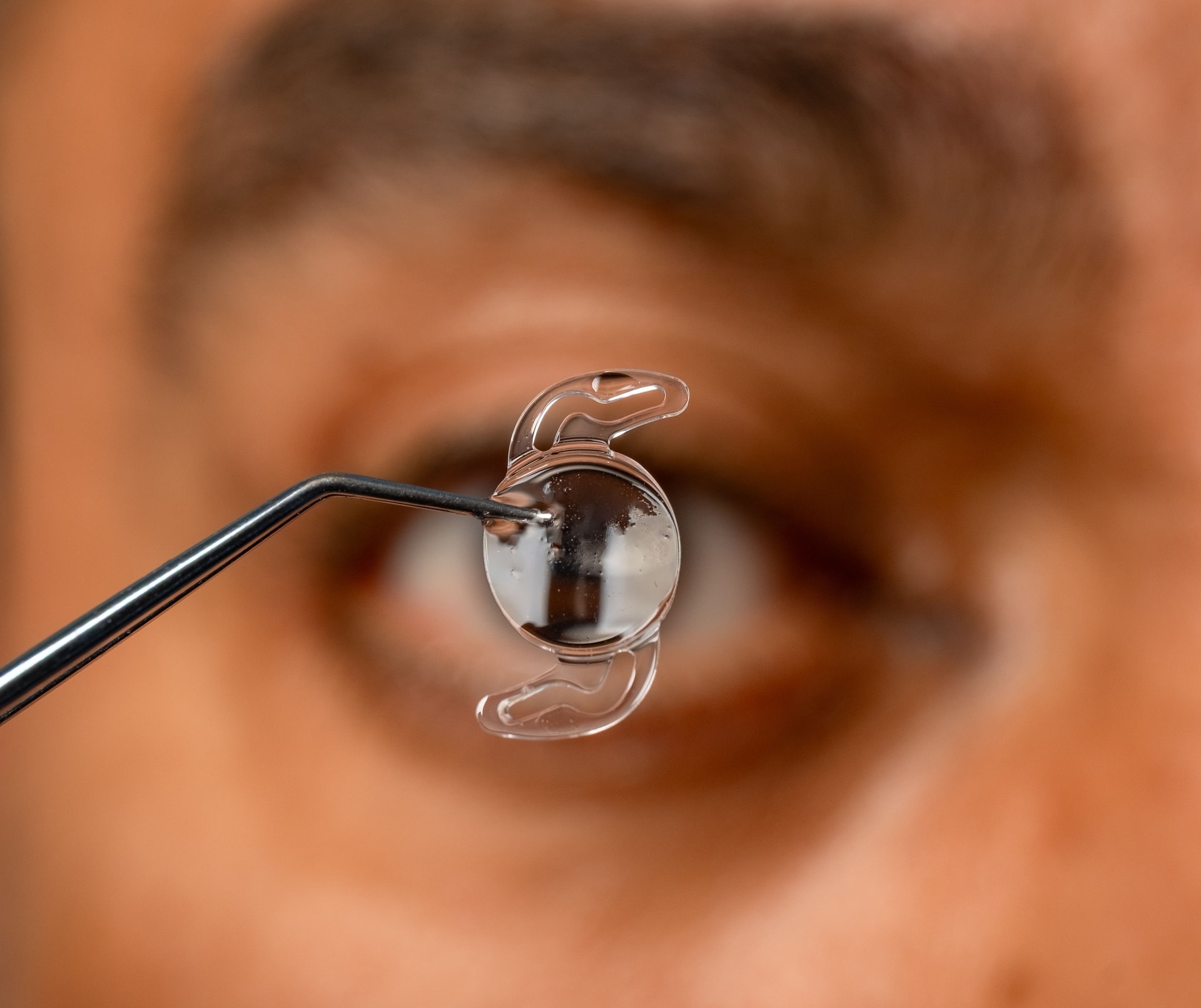 Implantation von Linsen bei Fehlsichtigkeit