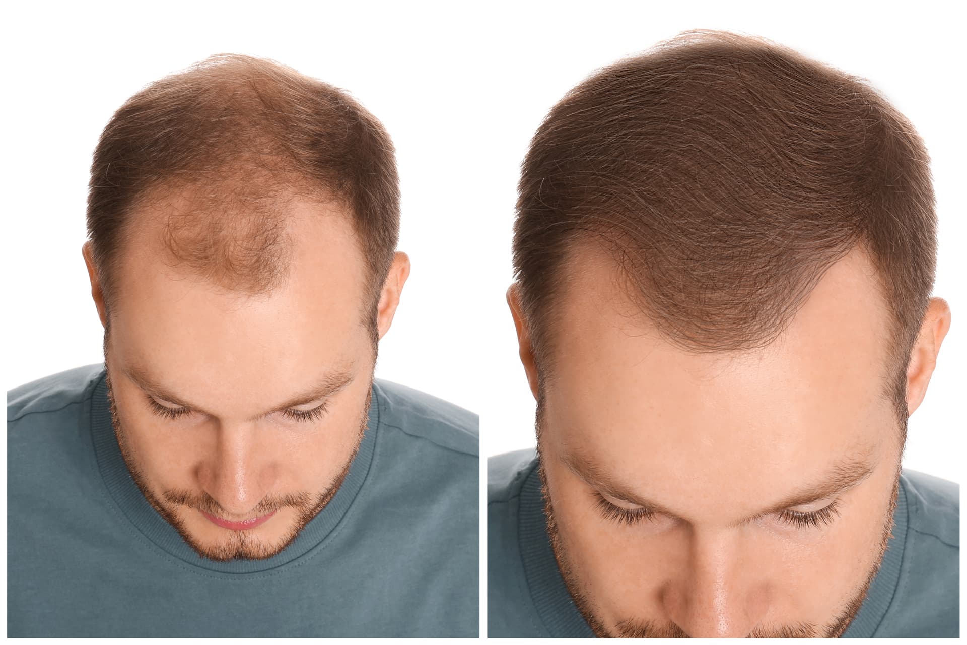 Haartransplantation Ablauf: Von der Beratung bis zum endgültigen Ergebnis