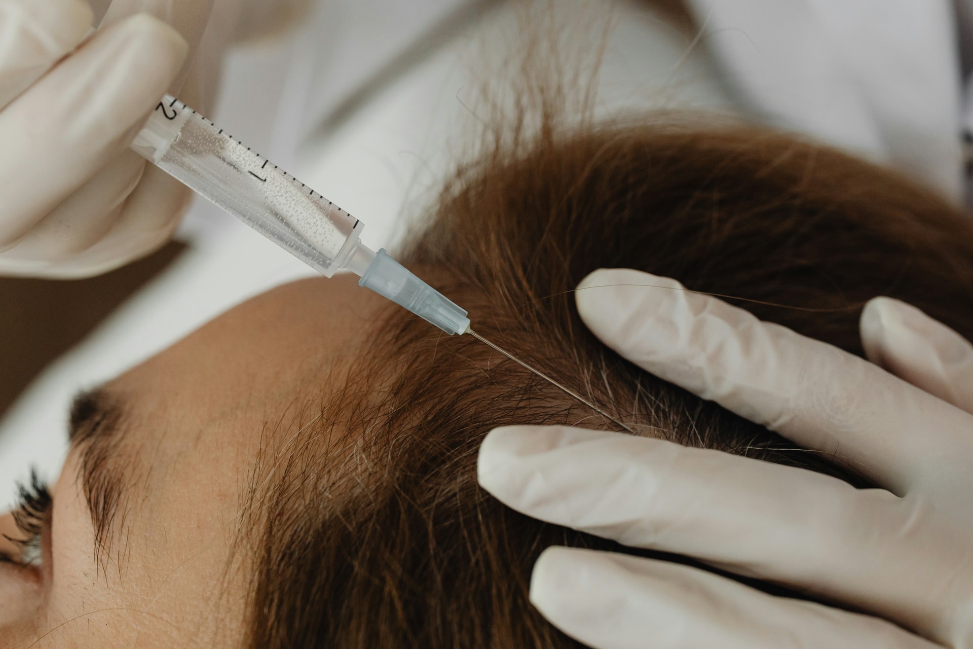 PRP-Haarregenerationstherapie