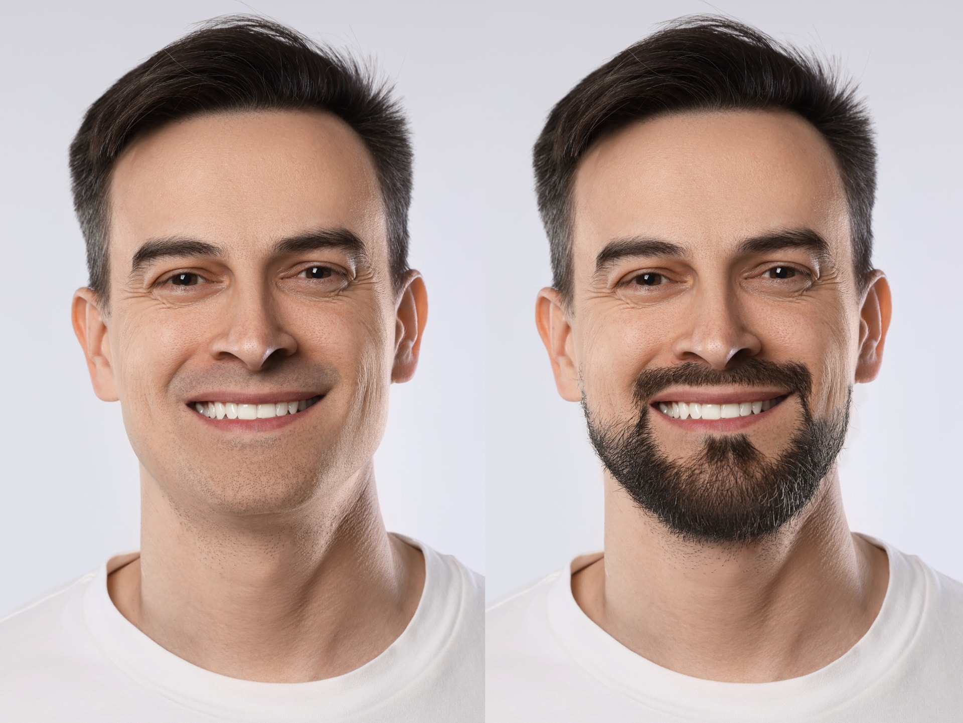 Barttransplantation